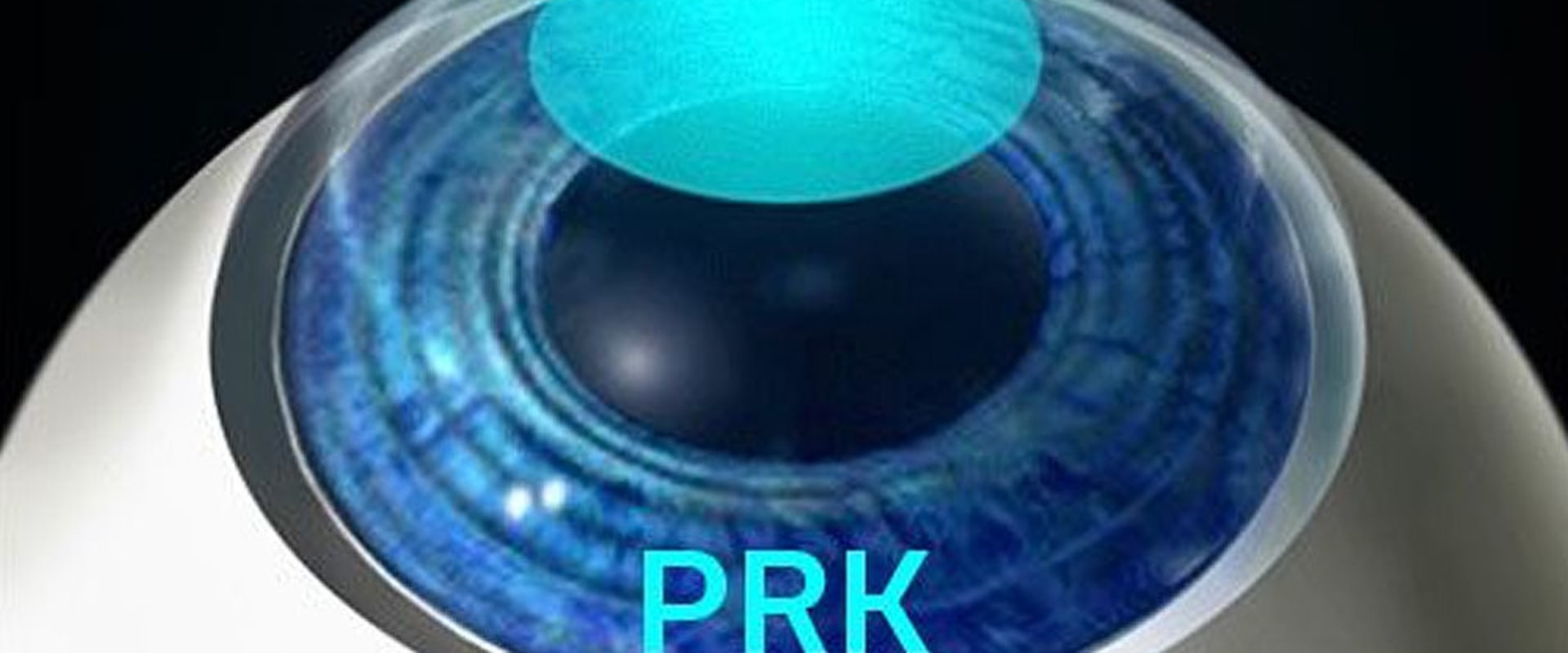 What is PRK?