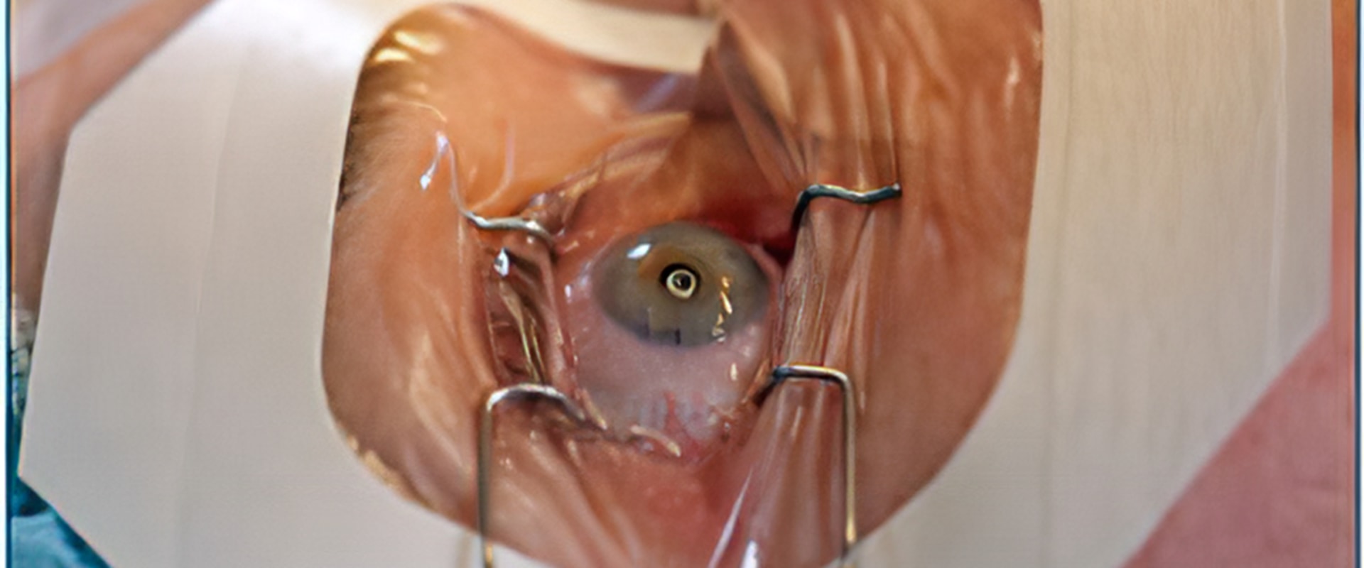 Types of Vision Correction Surgery
