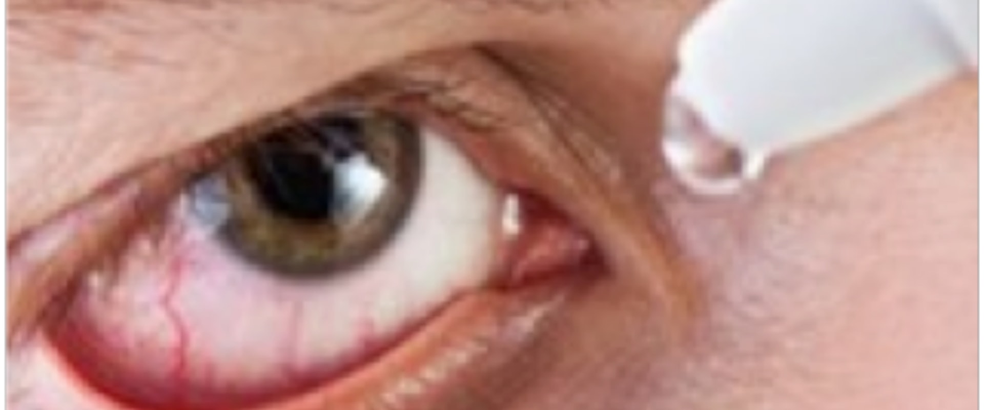 Understanding Dry Eyes After PRK