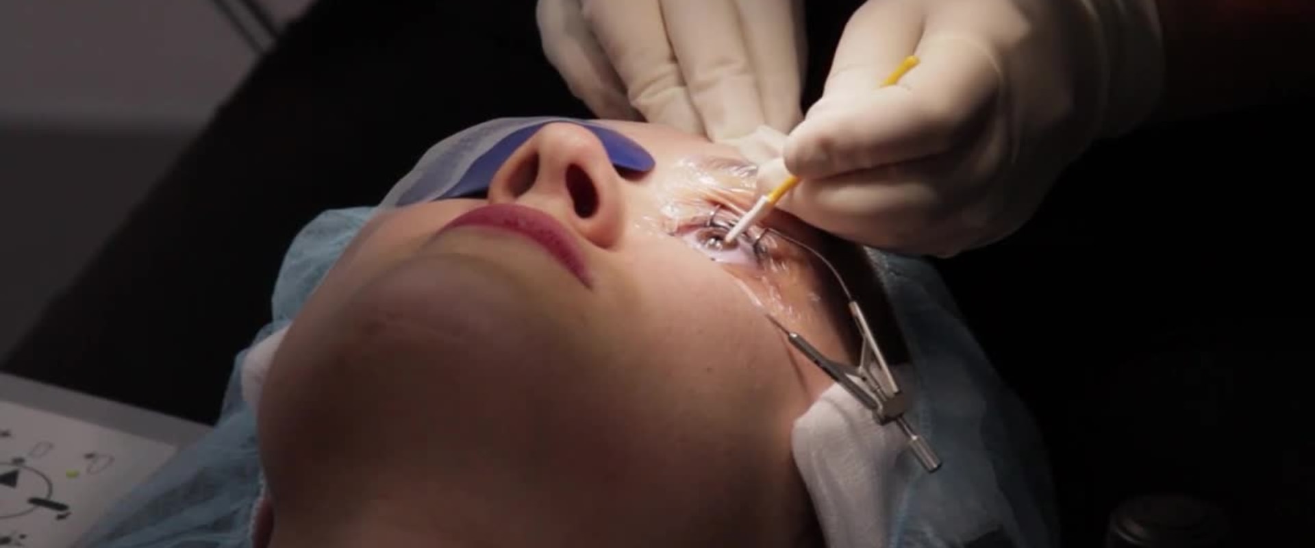 Benefits of PRK: Overview and Procedure