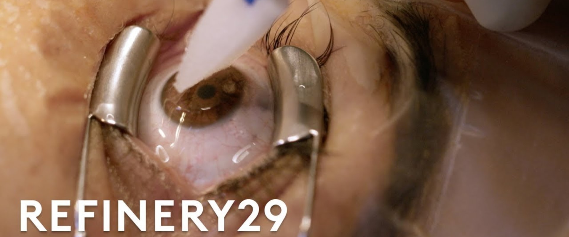 PRK Eye Surgery Steps