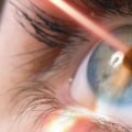 The Advantages of Laser Eye Surgery