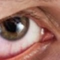 Understanding Dry Eyes After PRK