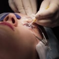 Benefits of PRK: Overview and Procedure