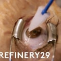PRK Eye Surgery Steps