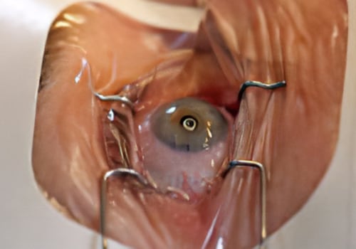 Types of Vision Correction Surgery