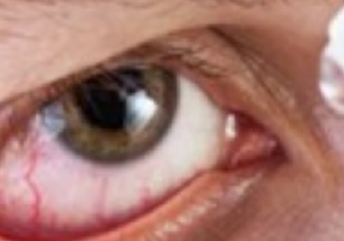 Understanding Dry Eyes After PRK