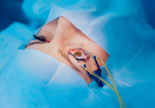 Protecting Your Eyes After PRK Surgery