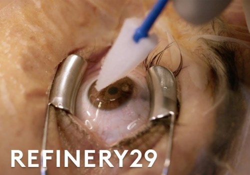 PRK Eye Surgery Steps